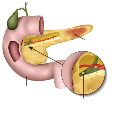 панкреатит - воспаление поджелудочной железы